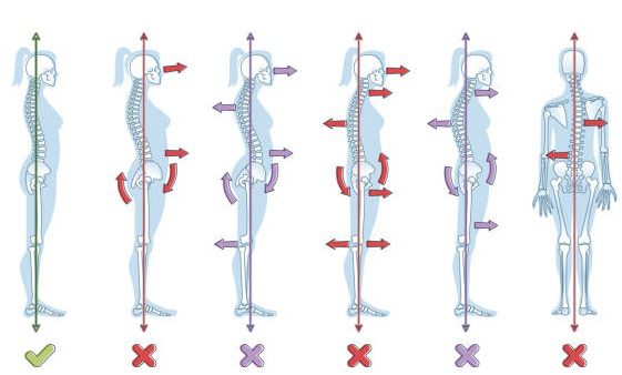 Types of standing postures and medical back pathology set outline diagram. Educational labeled collection with spine curvature problems compared to healthy neutral balanced example vector illustration