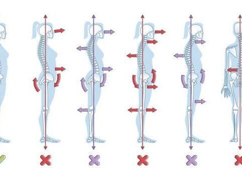 Types of standing postures and medical back pathology set outline diagram. Educational labeled collection with spine curvature problems compared to healthy neutral balanced example vector illustration