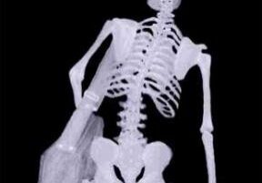 x-ray of body leaning due to carring heavy bag